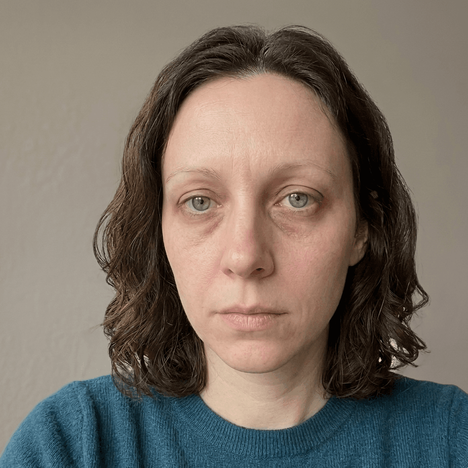 Under-Eye Hollowness